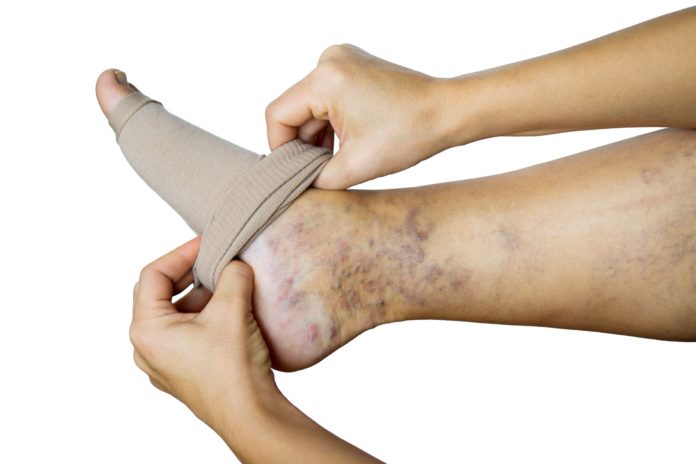 woman puts compression hose on leg with varicose veins