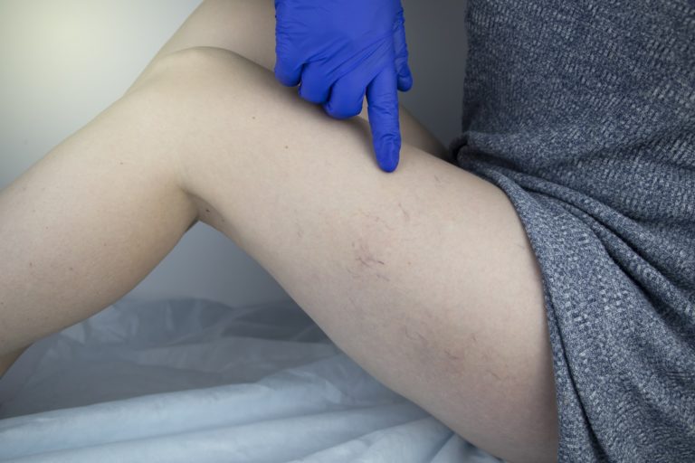 physician examines varicose veins on young woman's leg